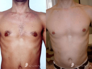 QUANTA SYSTEM Light A