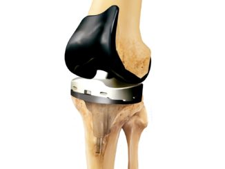 Smith & Nephew Orthopaedic Reconstruction