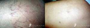 QUANTA SYSTEM Light A